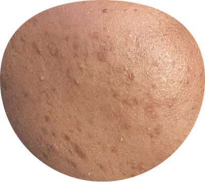 Acne Scars & Blemishes